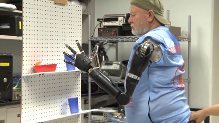 amputee prosthetic limb